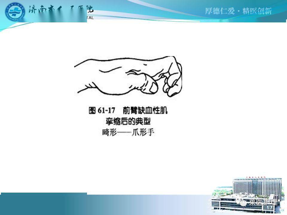 【ppt】骨筋膜室综合症的观察及护理