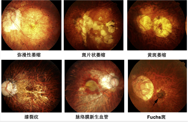 重视眼球形态与眼轴—魏文斌教授谈病理性近视