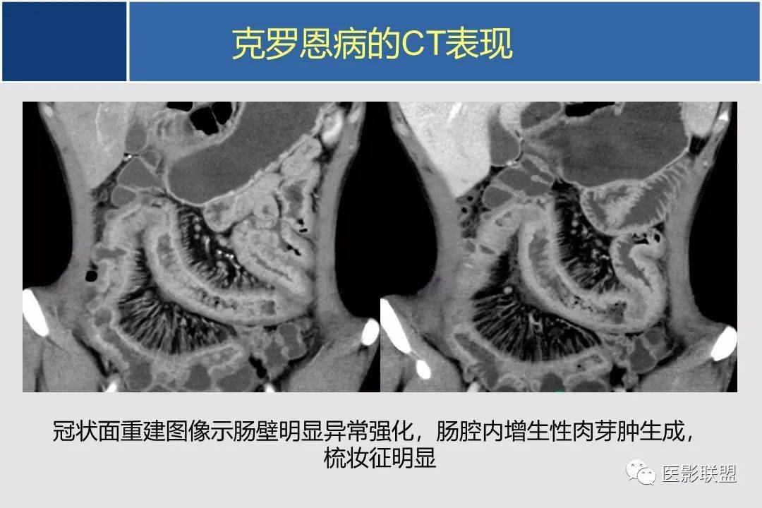 小肠ctmr影像诊断及进展