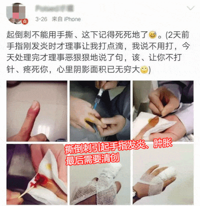 到底还要撕倒刺,死皮到什么时候?教你1招,统统搞定!