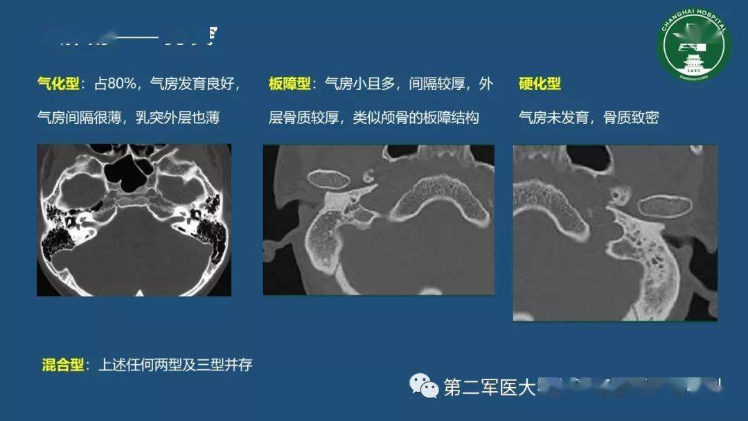 颞骨ct解剖及其常见病变