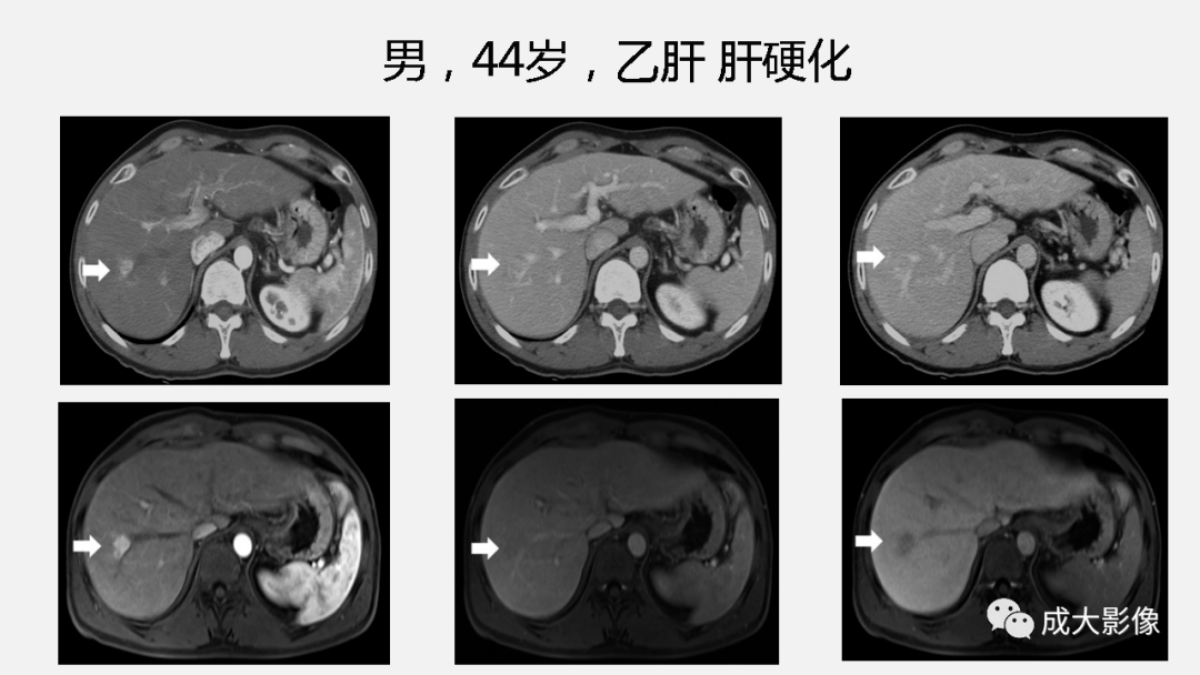 精彩课件丨胆管细胞癌影像与临床
