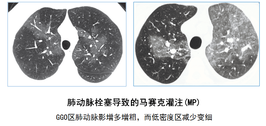 马赛克衰减模式的影像学表现与临床意义