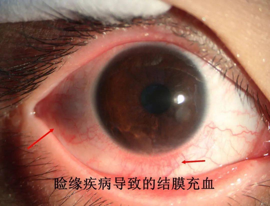 What is a Subconjunctival Hemorrhage? | Premier Eye Associates