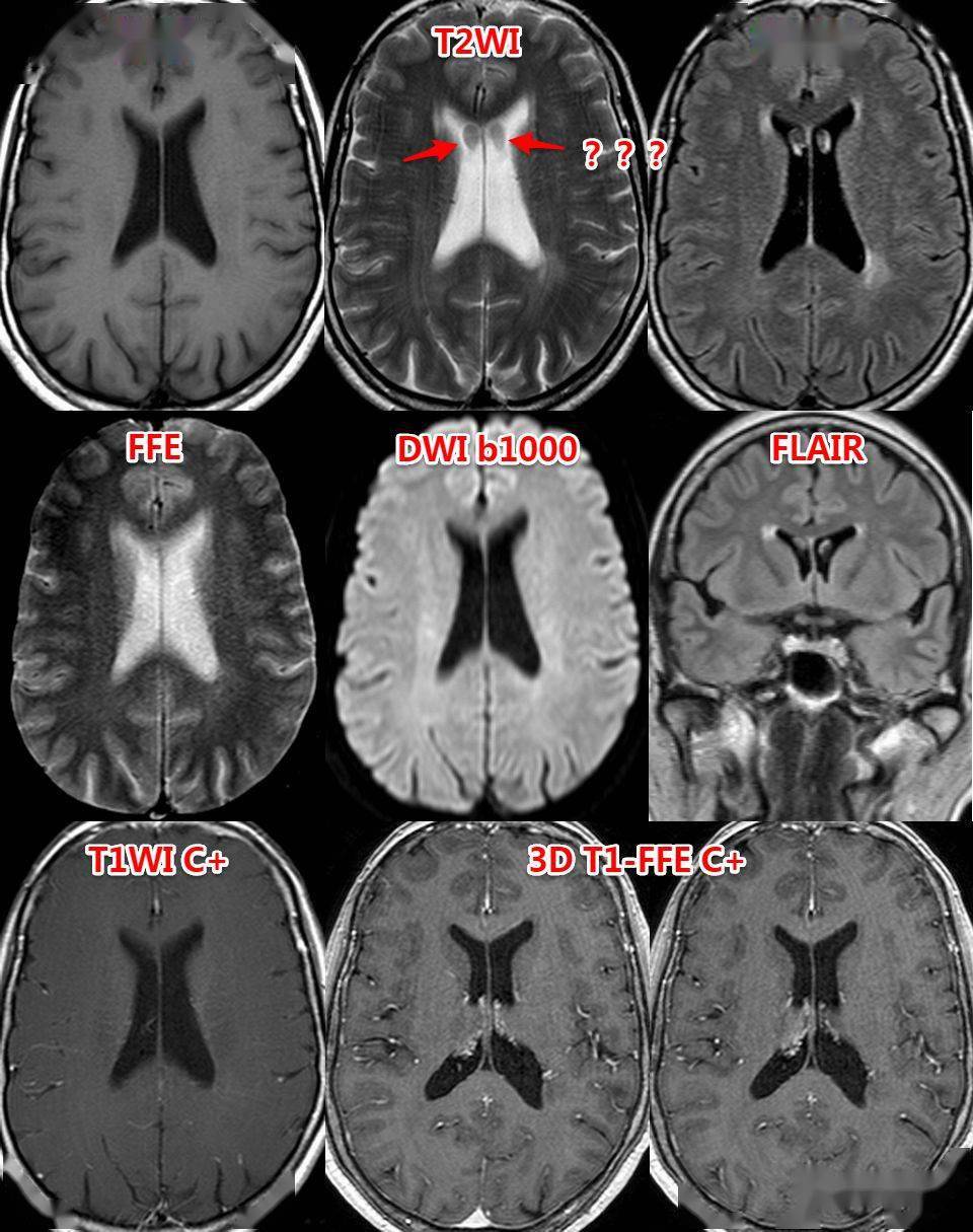 入门必读:头颅mri易误诊影像,赶紧收藏!