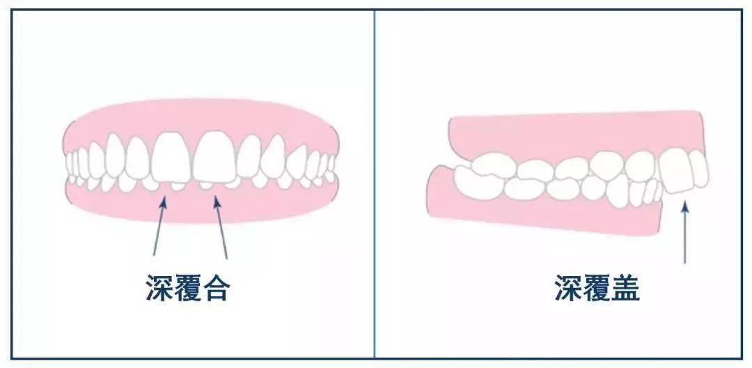 深覆盖怎么办