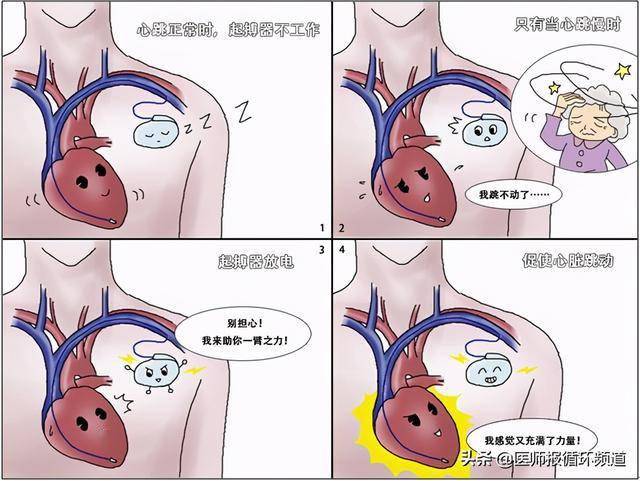 为什么都说起搏器是心脏的充电器?啥意思?