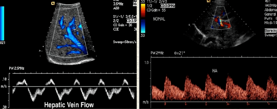 cdfi检查:肝静脉呈三相波型频谱.