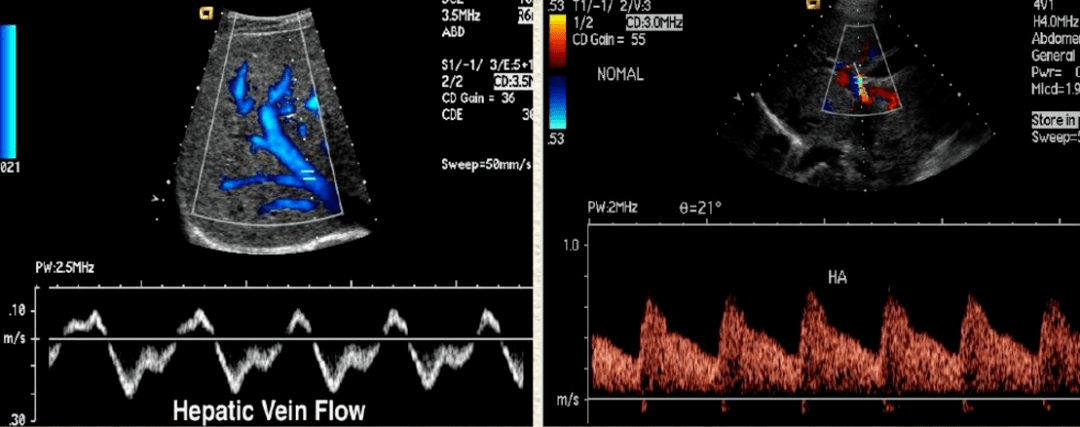 肝脏超声声像图表现及常用正常值_门静脉