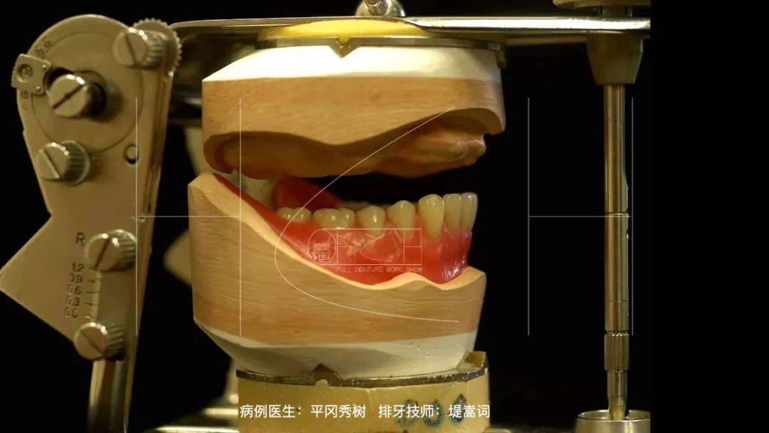 真正的"以与有牙颌相同的概念决定了排列位置"的全口义齿临床排牙病例