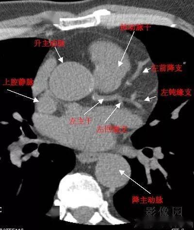 什么情况才需要做冠状动脉CT 2c0412e79b8142ddba5422237cf5229f.jpeg