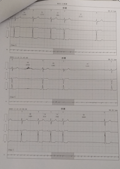 图示:患者24小时动态心电图结果