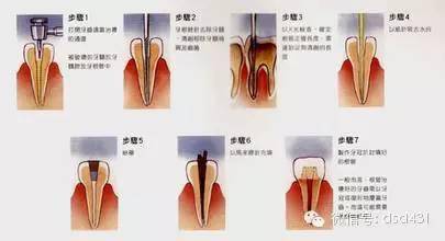 2)急性牙髓炎牙髓充血厉害,不要怕,一般常见开髓后5--10分钟内有