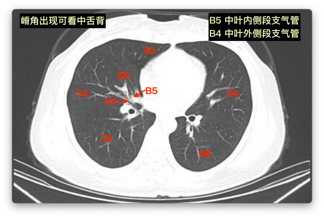 支气管分出的层面,形似"嵴角,此时可见右肺中叶(左肺舌段)和下叶背段