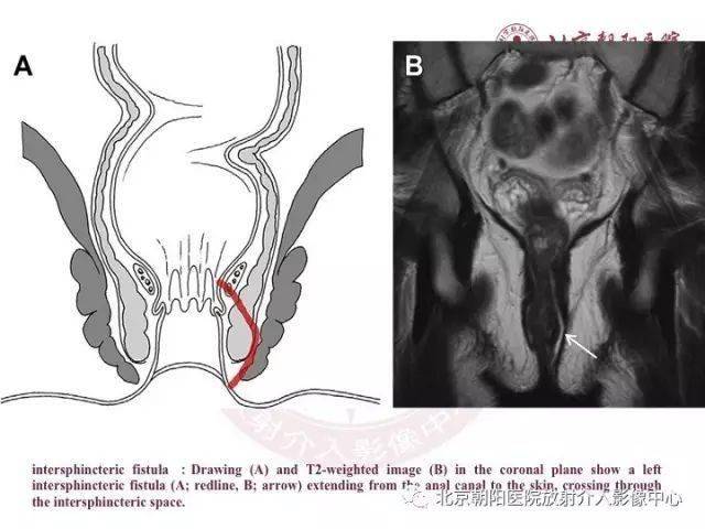 图解肛瘘的解剖和影像诊断