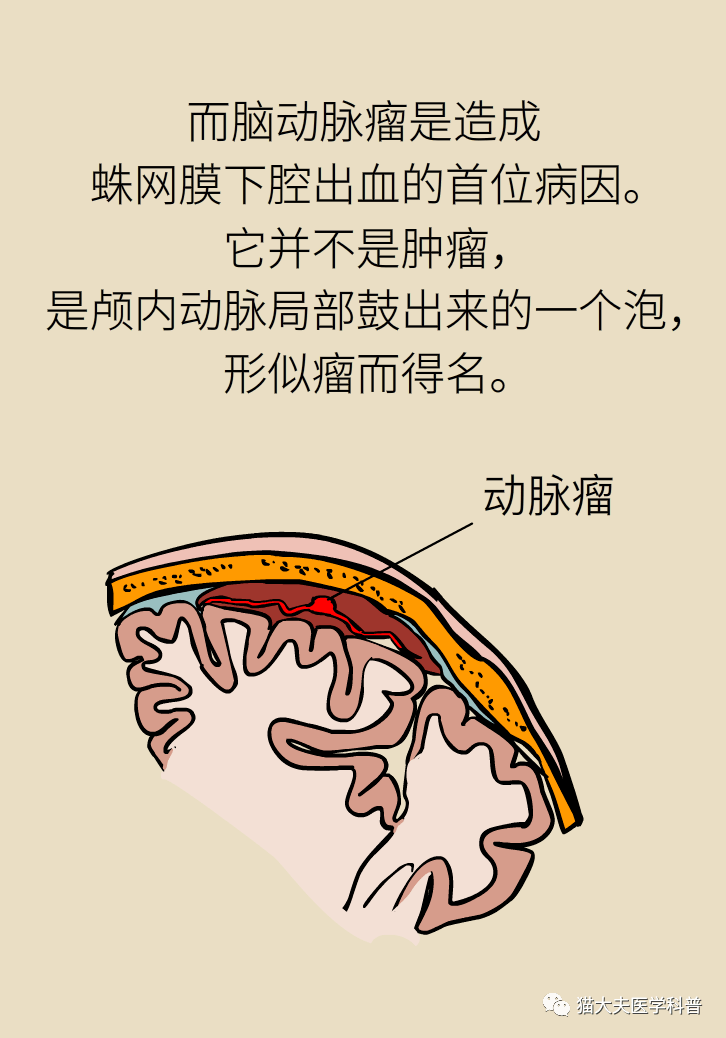 脑动脉瘤之一 脑动脉瘤是脑卒中吗?