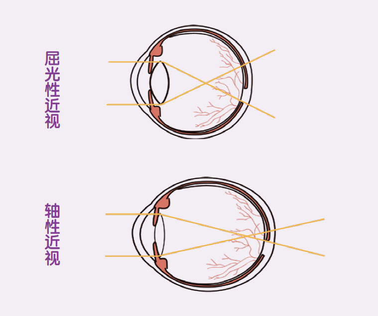 轴性近视:眼轴长度超过正常范围,角膜和晶状体等眼其他屈光成分基本
