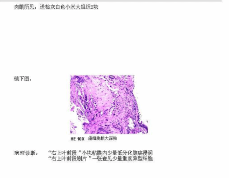 峰回路转,柳暗花明:地舒单抗在晚期肺癌骨转移治疗中尽显实力
