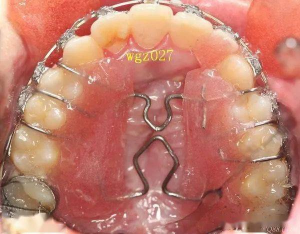 二手病例腭裂术后前牙开合矫治进展组图