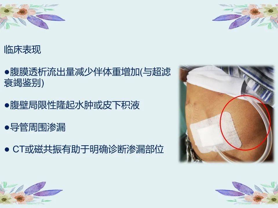 【ppt】腹膜透析置管术后早期并发症的护理