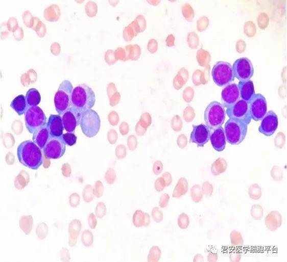 edta—k2 抗凝外周血浆细胞聚集-原发性浆细胞白血病漏诊一例