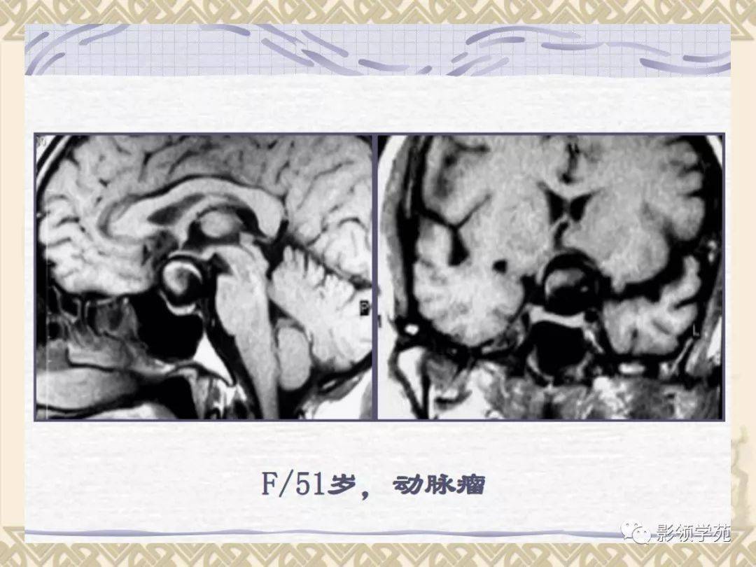 垂体病变的mri诊断