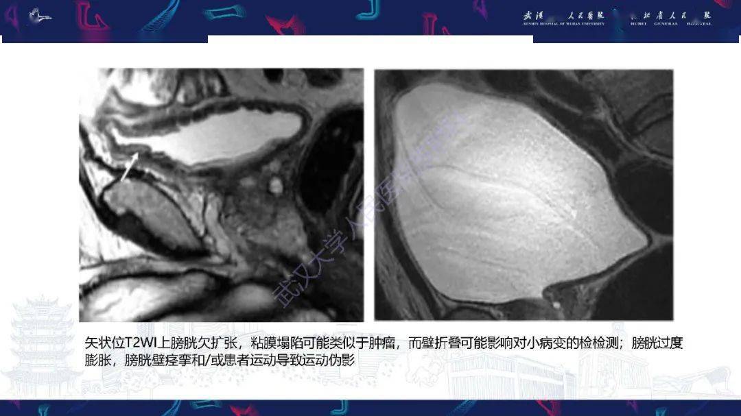 一文读懂膀胱癌mri诊断及分期