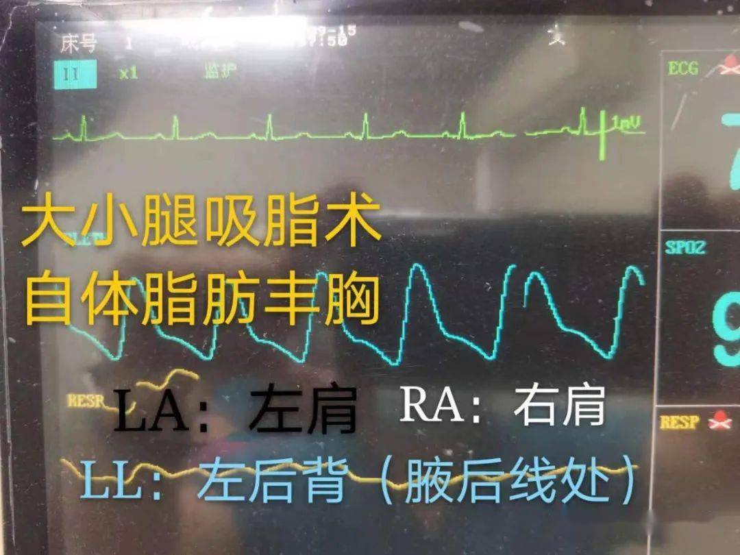 (三)血氧饱和度: 大家都会,一般是放置在手指上,避免与血压计放置在