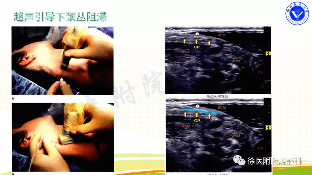 超声引导下颈丛神经阻滞超声系列课