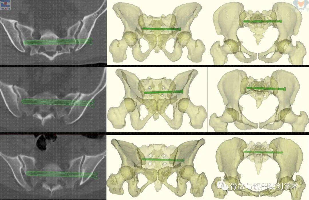 骶髂螺钉正确指向图解:通晓规律,免除错误,远离危险