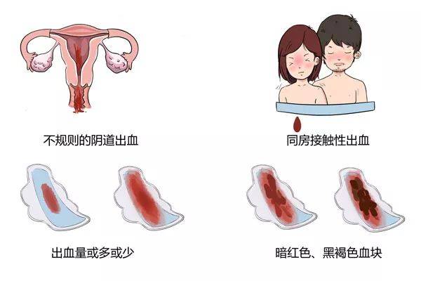 阴道出血 | 判断是宫颈出血还是月经?