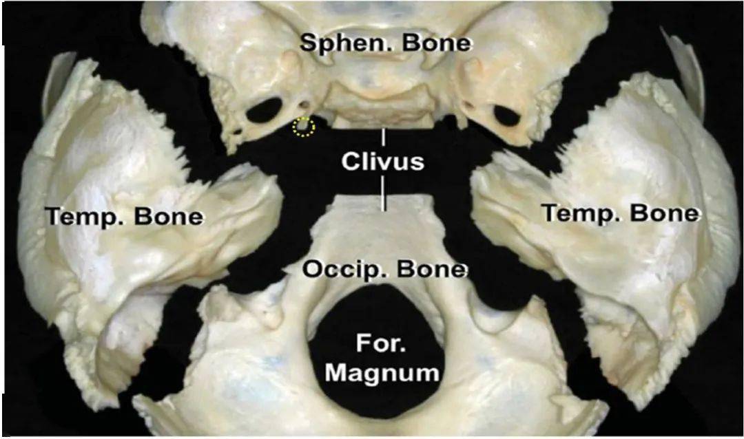 蝶骨,颞骨,枕骨.黄色虚线圈,系笔者添加,示意蝶骨舌突.
