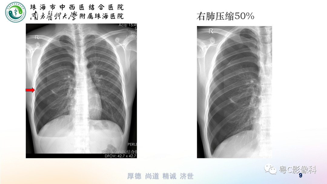 气胸胸腔积液肋骨骨折影像表现