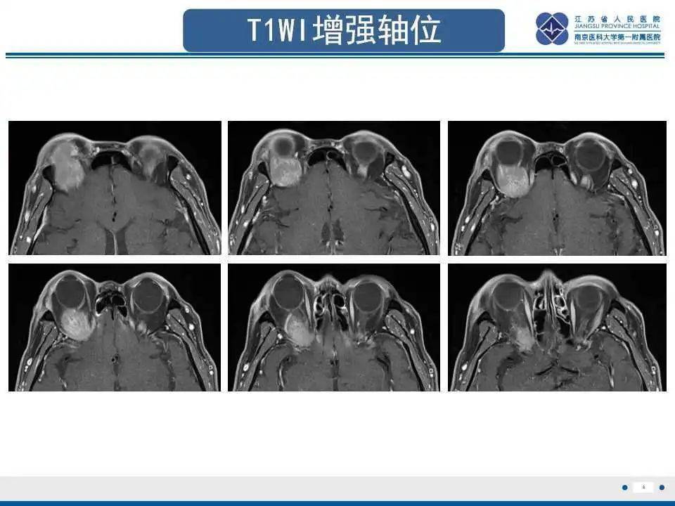 每日一例1217眼眶淋巴瘤影像表现右眼球胀痛突出半年