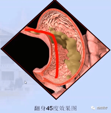 吃饭进到鼻子里怎么办