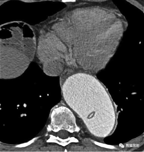 格艾选读丨获得性主动脉异常机理ct表现鉴别诊断