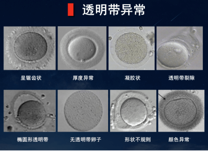 医生说我的卵子透明带异常,这是怎么回事?