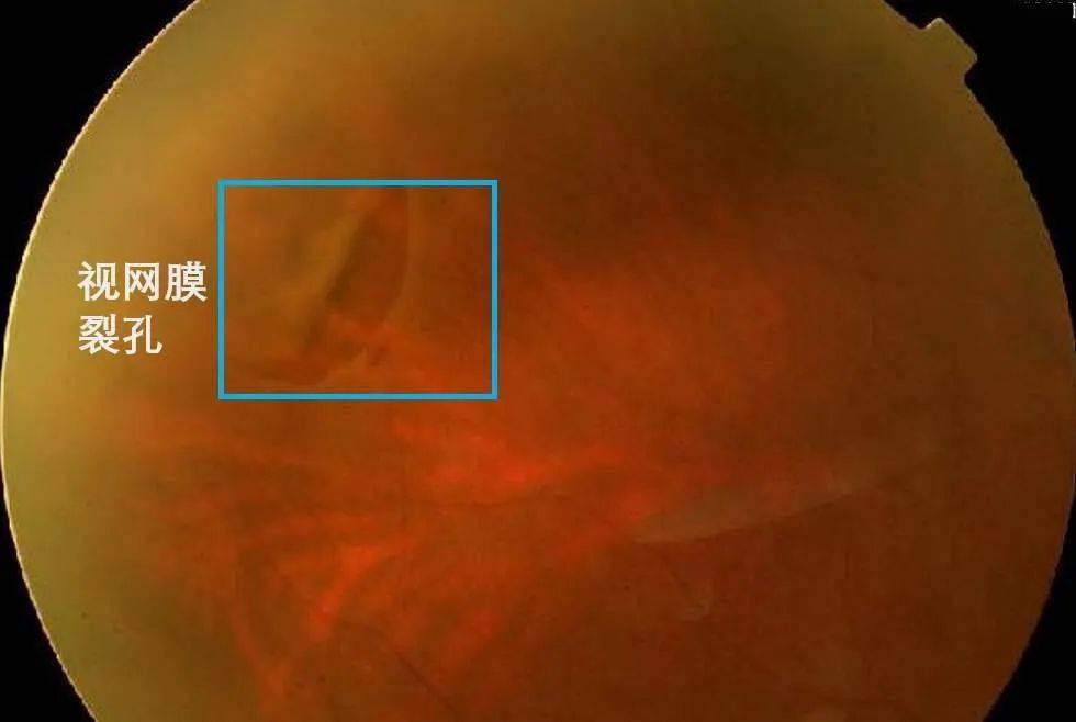 出现裂孔之后,如果再伴有玻璃体液化等很多其他问题,就会出现了视网膜