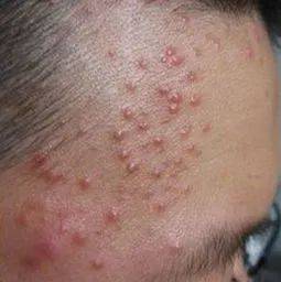 而青春痘在医学上叫做痤疮,是一种累积毛囊上的皮脂过多,而形成的一