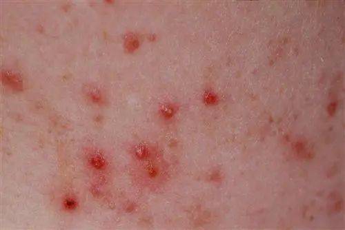 皮肤|毛囊炎不可怕,可怕的是误把毛囊炎当痘痘来治!