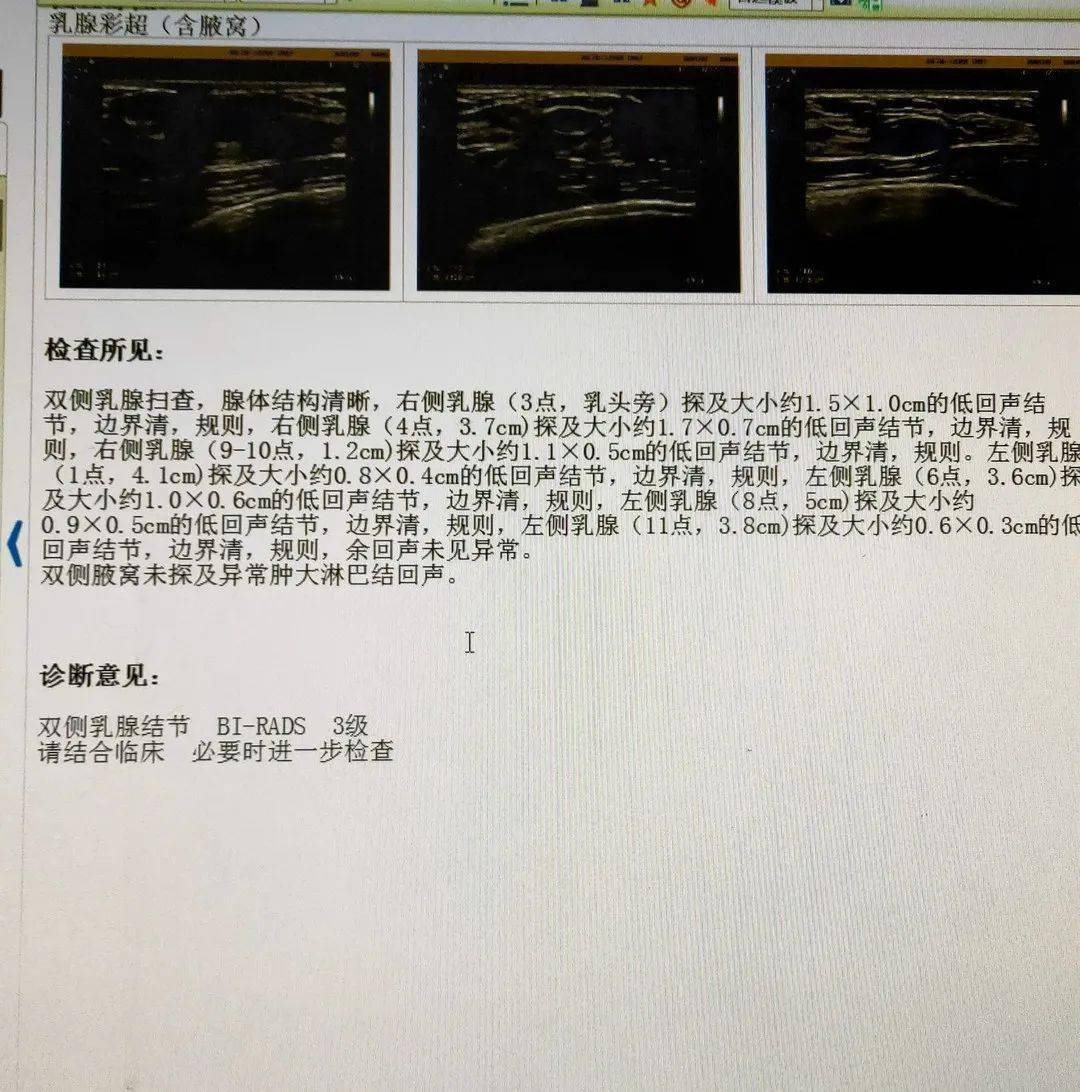 不开刀治疗乳腺多发结节——泰安市第一人民医院开展超声引导下乳腺