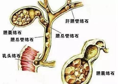 《阳光诊疗室》:不吃早餐,易患胆结石!