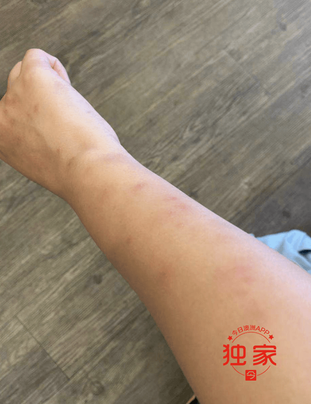 宜家床垫冒出无数床虱,澳华女浑身起包直呼"恶心"!