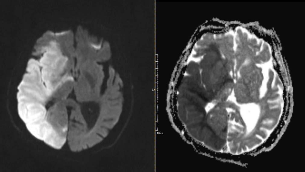 ct: t2wi mra mri 提示右侧大脑半球大面积脑梗死,右侧大脑中动脉闭塞