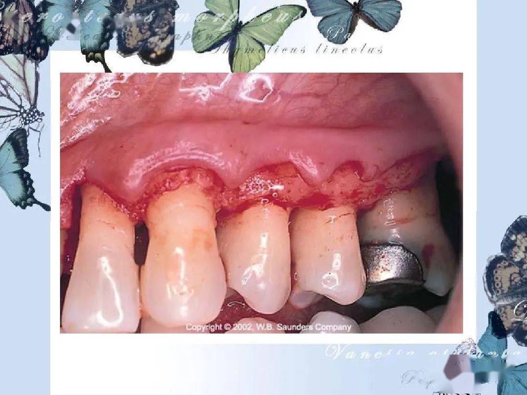 牙槽骨的吸收程度和类型