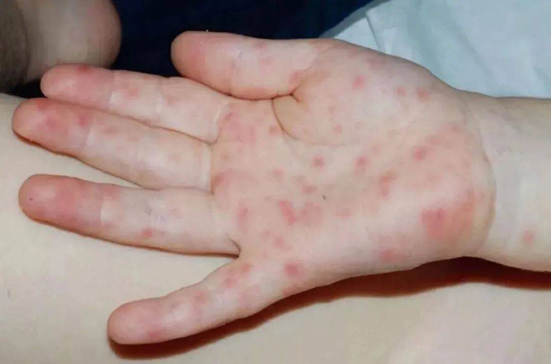 手足口,幼儿急疹,水痘,风疹,川崎病……看图识别不同皮疹,附治疗和