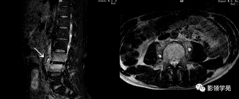 布氏杆菌性脊柱炎影像学表现