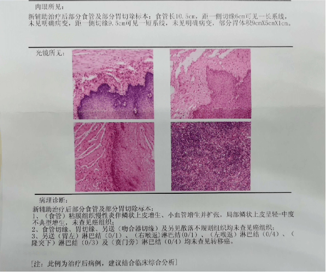 新辅助免疫联合化疗用于局晚期食管鳞癌患者,3周期达术后病理pcr!