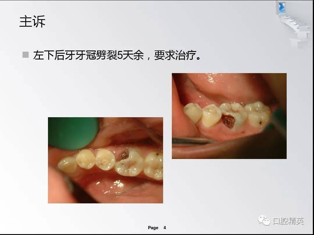 龈切术与冠延长术