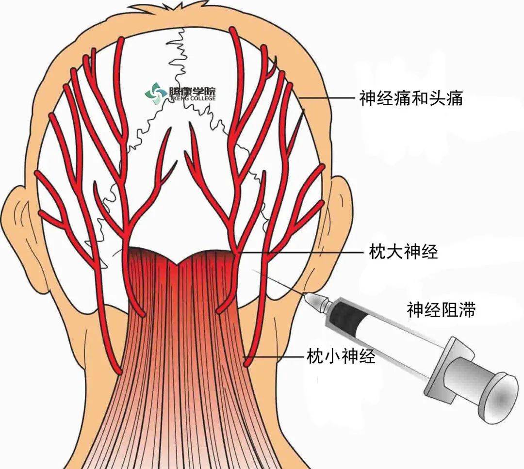 由于内颈动脉周围的海绵静脉洞神经丛中的血清胺这种化学传递物质作祟